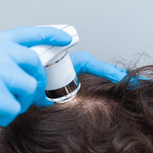 Trichoscopy of hair and scalp closeup. Trichoscope in the hands of a doctor. Scalp and hair examination procedure